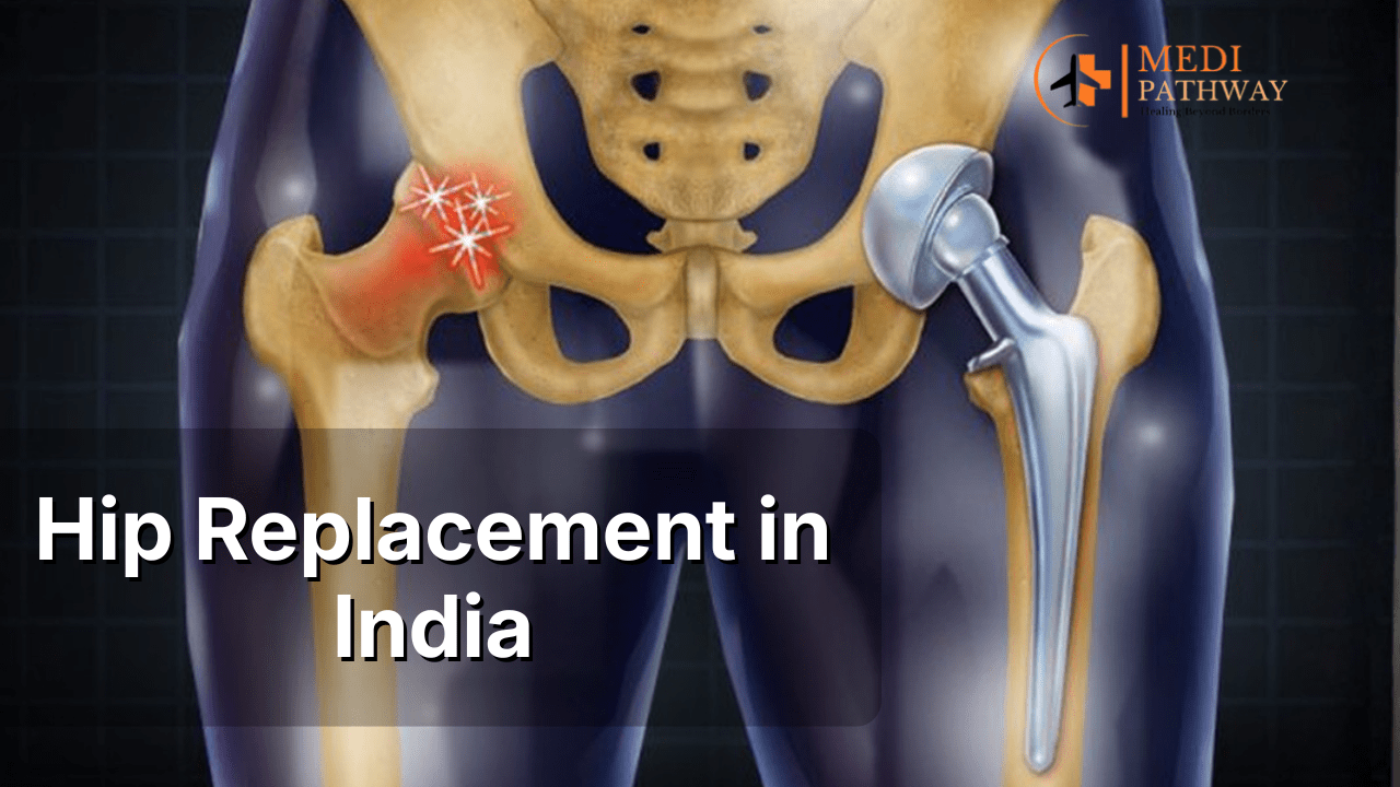 Hip Replacement in India