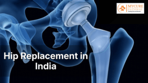 Hip Replacement in India
