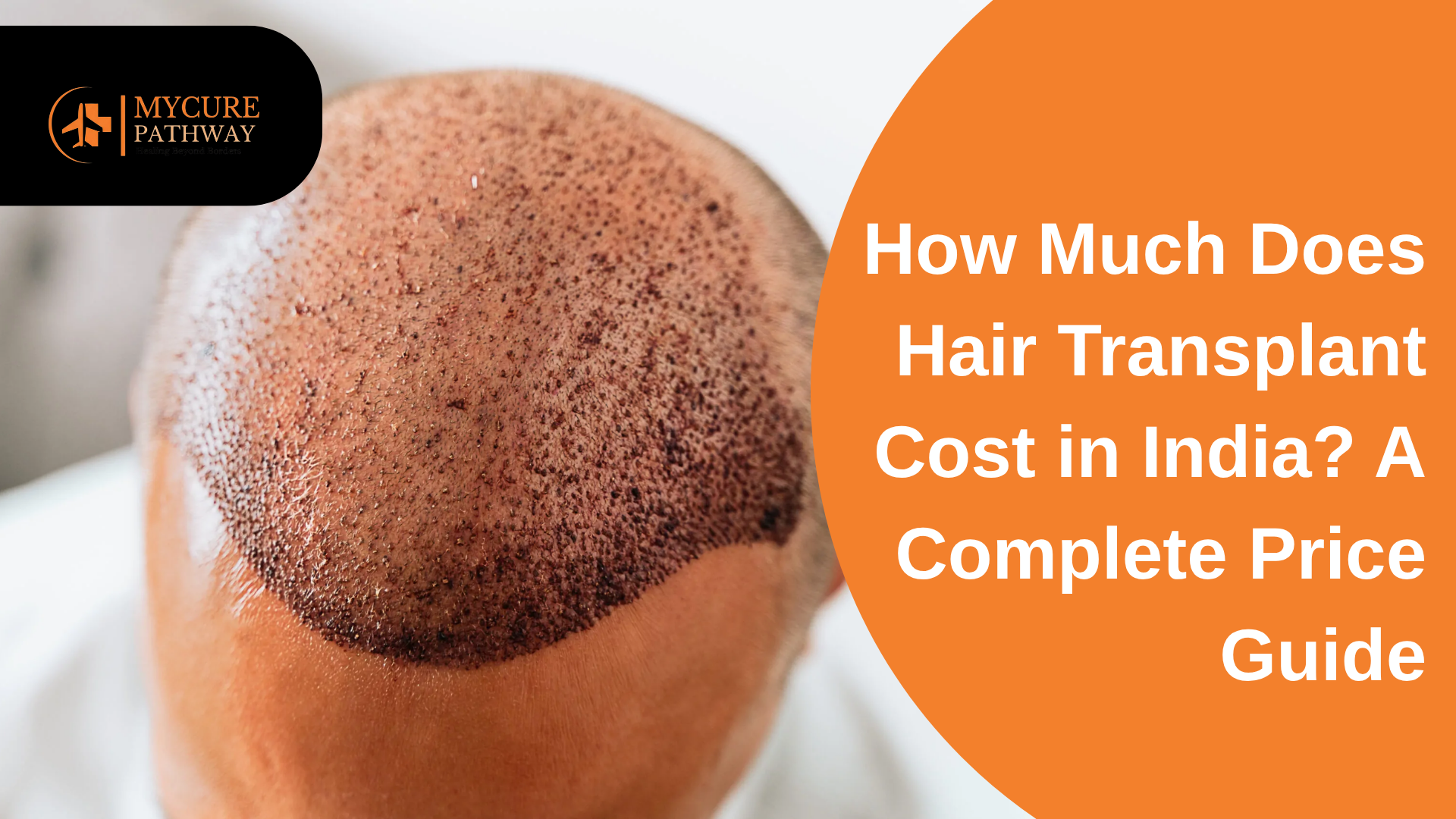 Hair Transplant Cost in India