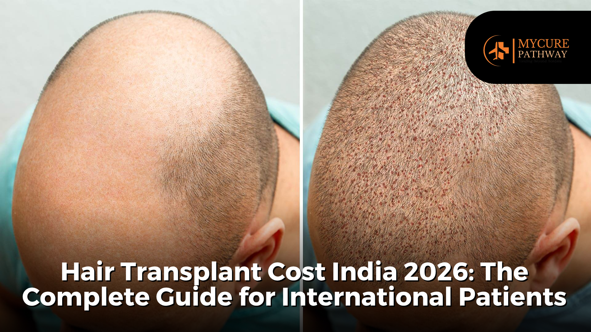 hair transplant in India