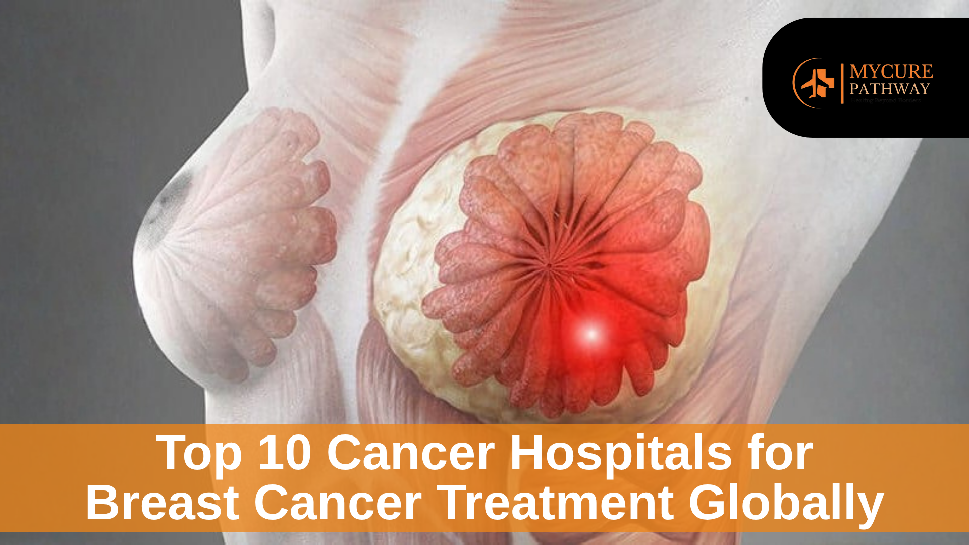 Top 10 Cancer Hospitals for Breast Cancer Treatment Globally