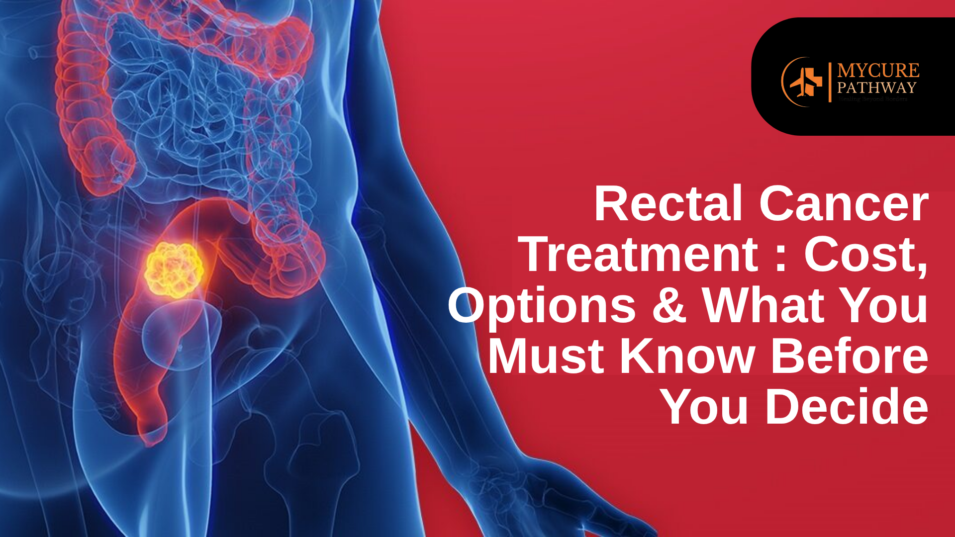 Rectal Cancer Treatment