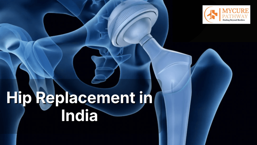 Hip Replacement in India